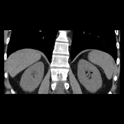 Adrenal gland trauma (Radiopaedia 81351-95079 Coronal non-contrast 64).jpg
