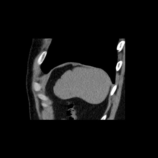 File:Adrenal gland trauma (Radiopaedia 81351-95079 Sagittal non-contrast 90).jpg