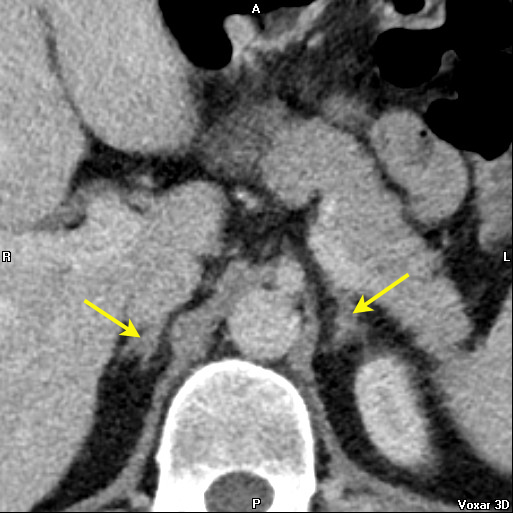 File:Adrenal glands (normal CT anatomy) (Radiopaedia 16570-16257 A 1).jpg