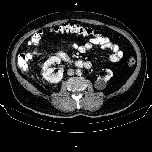 Adrenal hemorrhage (Radiopaedia 62622-70916 Axial C+ portal venous phase 92).jpg