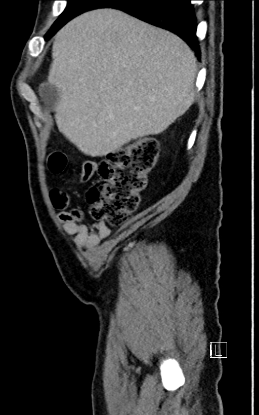 Adrenal lymphoma (Radiopaedia 73730-84529 Sagittal C+ portal venous phase 15).jpg