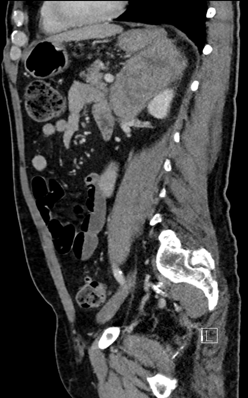 Adrenal lymphoma (Radiopaedia 73730-84529 Sagittal C+ portal venous phase 72).jpg