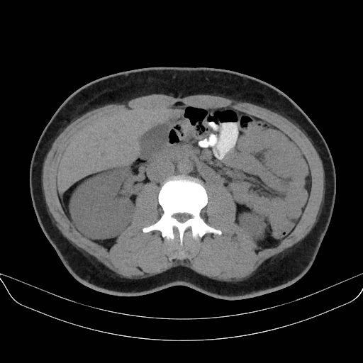 Adrenal myelolipoma - bilateral (Radiopaedia 74805-85810 Axial non-contrast 36).jpg