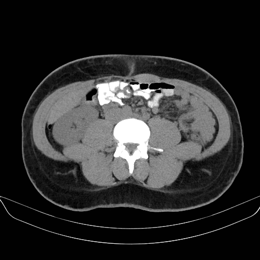 Adrenal myelolipoma - bilateral (Radiopaedia 74805-85810 Axial non-contrast 46).jpg