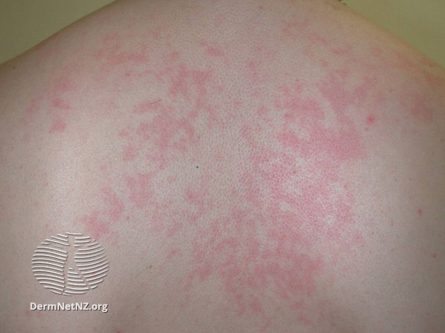 File:Adult-onset Still disease (DermNet NZ immune-stills).jpg