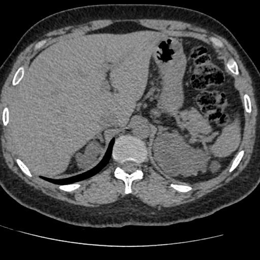Adult polycystic kidney disease (Radiopaedia 59075-66368 Axial non-contrast 8).jpg