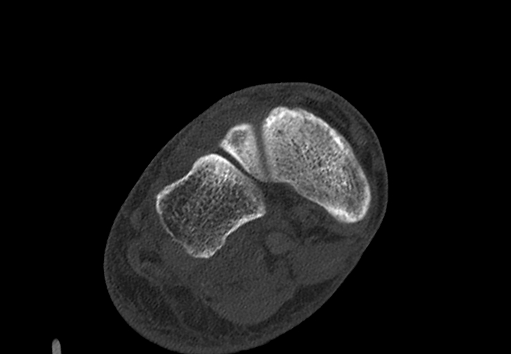 Advanced osteomyelitis due to open metatarsal fracture (Radiopaedia 83891-99095 Axial bone window 20).jpg