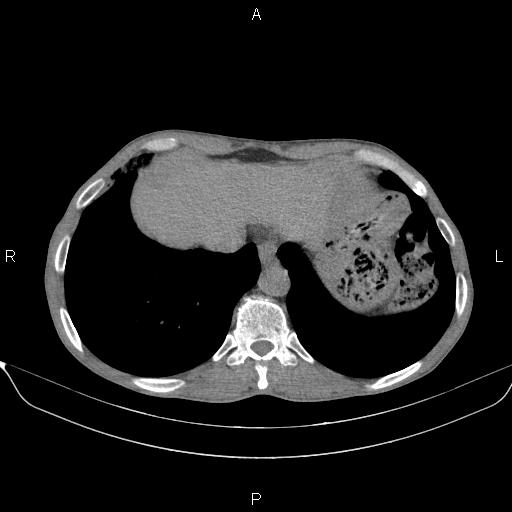 Air bronchogram in pneumonia (Radiopaedia 85719-101512 Axial non-contrast 56).jpg