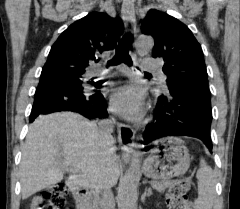 Airway foreign body in adult (Radiopaedia 85907-101779 Coronal liver window 147).jpg