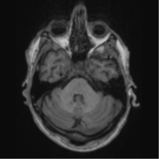 File:Alzheimer's disease- with apraxia (Radiopaedia 54763-61011 Axial T1 20).png