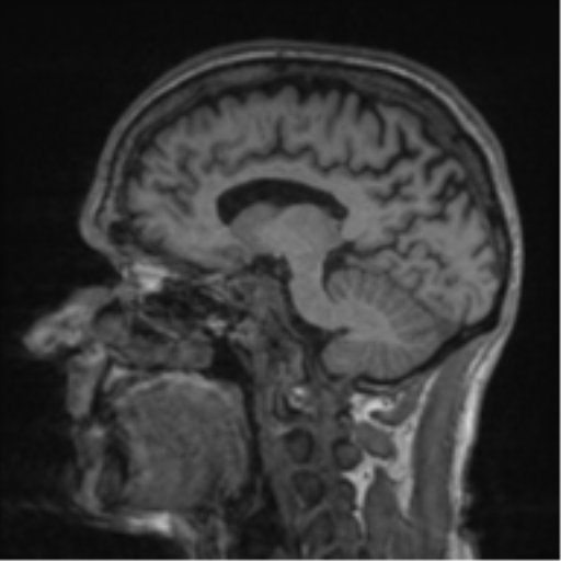 File:Alzheimer's disease- with apraxia (Radiopaedia 54763-61011 Sagittal T1 30).png