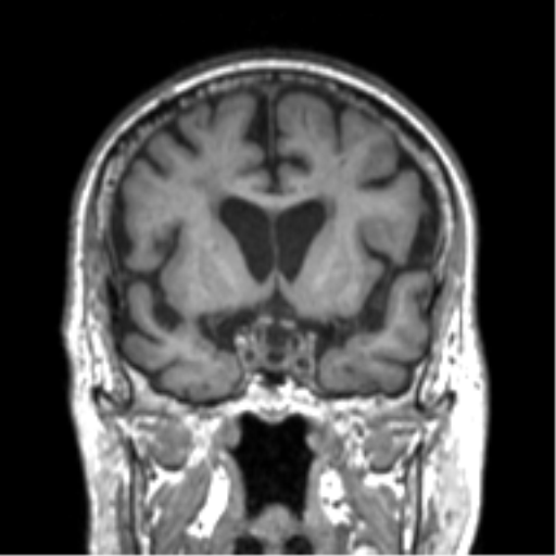 Alzheimer disease and cerebral amyloid angiopathy (Radiopaedia 64234-73011 Coronal T1 43).png