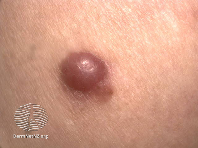 File:Amelanotic nodular melanoma (DermNet NZ 12a-amelanotic-melanoma).jpg