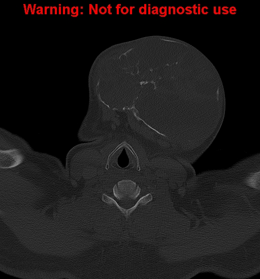 Ameloblastoma (Radiopaedia 33126-34164 Axial bone window 30).jpg