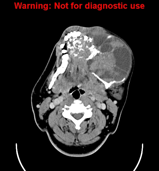 File:Ameloblastoma (Radiopaedia 33126-34164 B 11).jpg