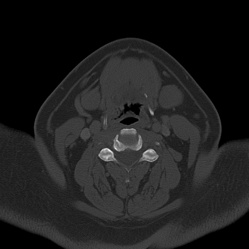 Ameloblastoma (Radiopaedia 38520-40623 Axial bone window 42).png