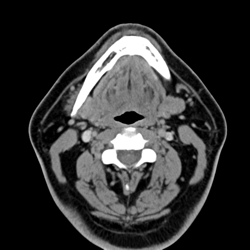 Ameloblastoma (Radiopaedia 38520-40623 Axial non-contrast 36).png