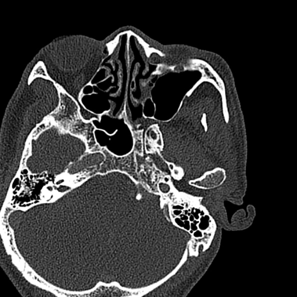 Ameloblastoma (Radiopaedia 51921-57766 Axial bone window 152).jpg