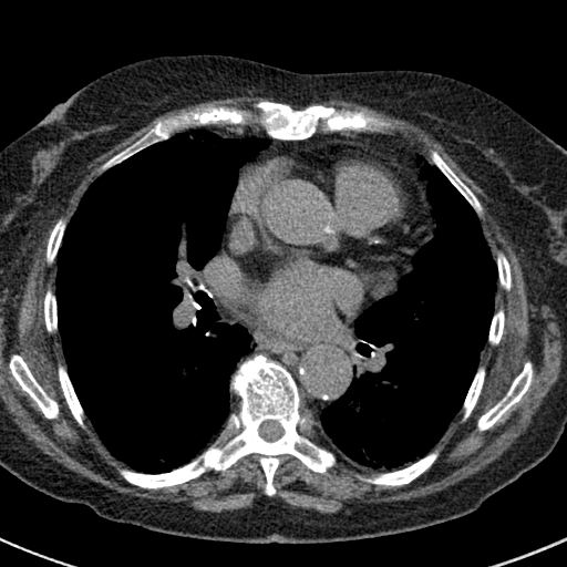 File:Amiodarone-induced pulmonary fibrosis (Radiopaedia 82355-96460 Axial non-contrast 34).jpg