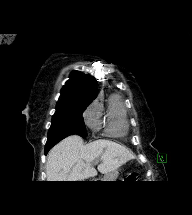 Amiodarone deposition in the liver (Radiopaedia 77587-89780 Coronal non-contrast 20).jpg