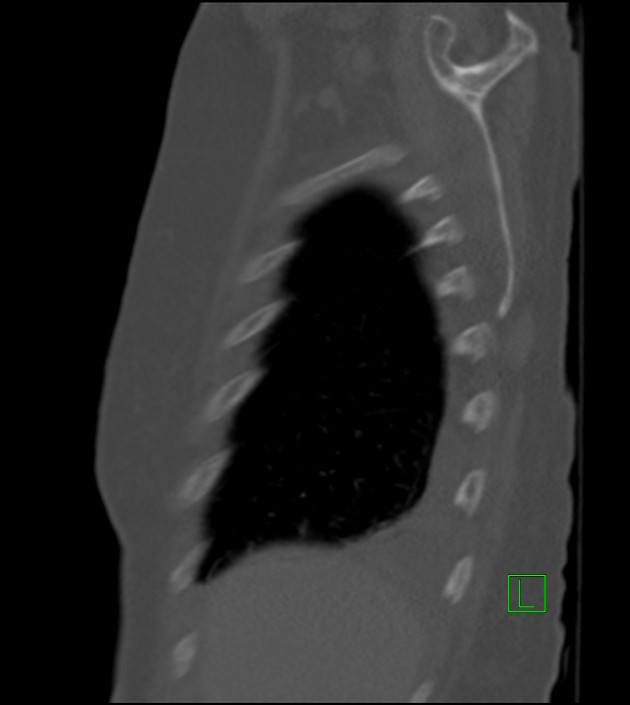 Amiodarone deposition in the liver (Radiopaedia 77587-89780 Sagittal bone window 83).jpg