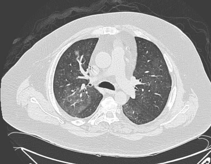 Amiodarone lung (Radiopaedia 62514-70769 Axial lung window 35).jpg