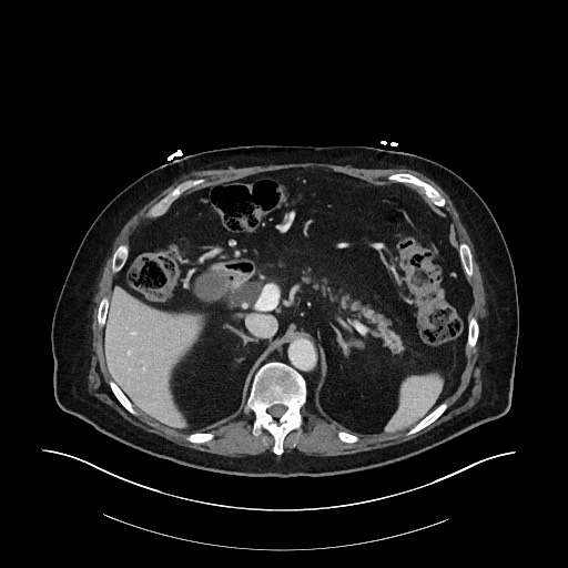 Ampullary adenocarcinoma (Radiopaedia 59373-66734 C 48).jpg