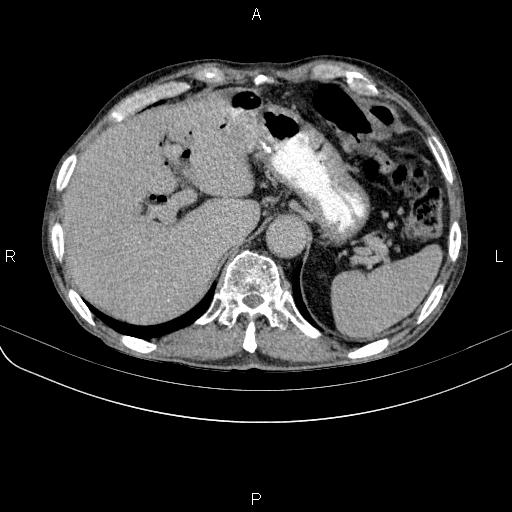 Ampullary adenocarcinoma (Radiopaedia 86093-102033 Axial C+ delayed 24).jpg