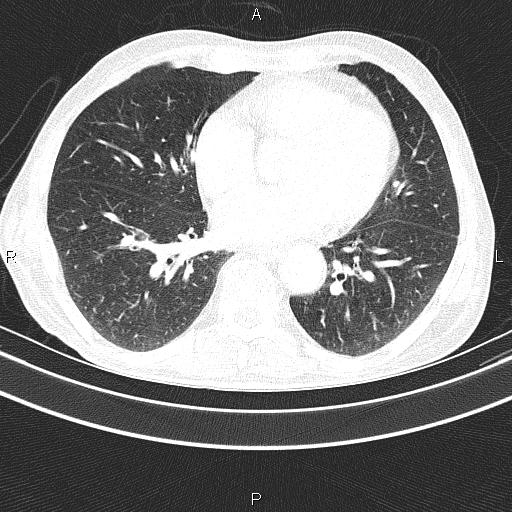 File:Ampullary adenocarcinoma (Radiopaedia 86093-102033 Axial lung window 39).jpg
