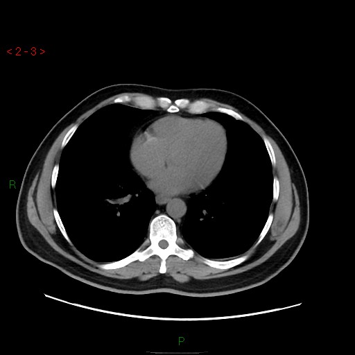 File:Ampullary carcinoma (Radiopaedia 56396-63056 Axial non-contrast 2).jpg