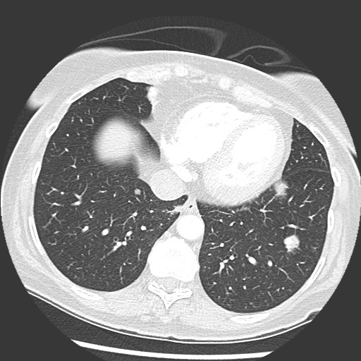 Amyloidosis - bronchial and diffuse nodular pulmonary involvement (Radiopaedia 60156-67745 Axial lung window 63).jpg