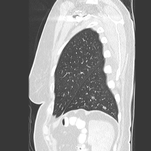 Amyloidosis - bronchial and diffuse nodular pulmonary involvement (Radiopaedia 60156-67745 Sagittal lung window 80).jpg