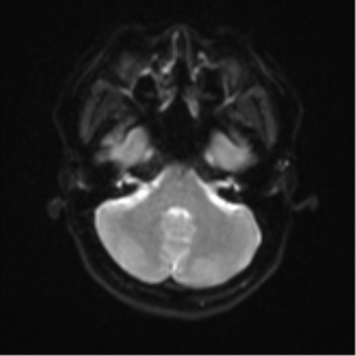 Anaplastic astroblastoma (Radiopaedia 55666-62194 Axial DWI 7).png