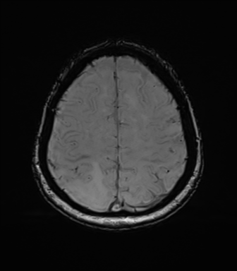 Anaplastic astrocytoma (Radiopaedia 86943-103160 Axial SWI 70).png