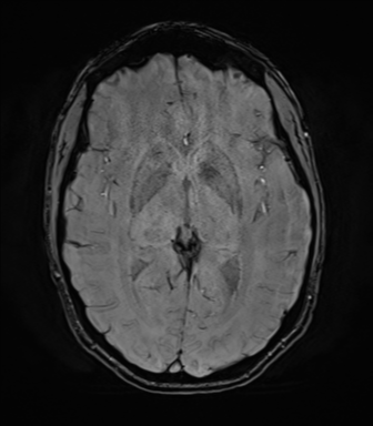 File:Anaplastic astrocytoma IDH mutant (Radiopaedia 50046-55341 Axial SWI 44).png