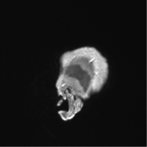 Anaplastic astrocytoma IDH mutant (Radiopaedia 50046-55341 Sagittal T1 C+ 9).png