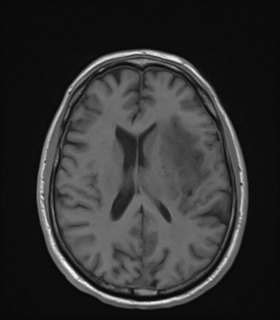 Anaplastic astrocytoma IDH wild-type (Radiopaedia 49984-55273 Axial T1 35).png