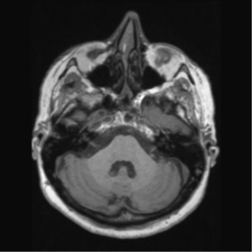 Anaplastic astrocytoma IDH wild-type (pseudoprogression) (Radiopaedia 42209-45276 Axial T1 43).png