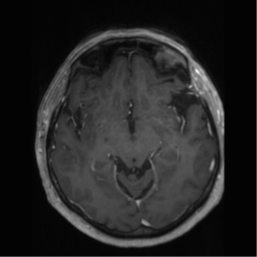 File:Anaplastic astrocytoma IDH wild-type (pseudoprogression) (Radiopaedia 42209-45277 Axial T1 C+ 52).png