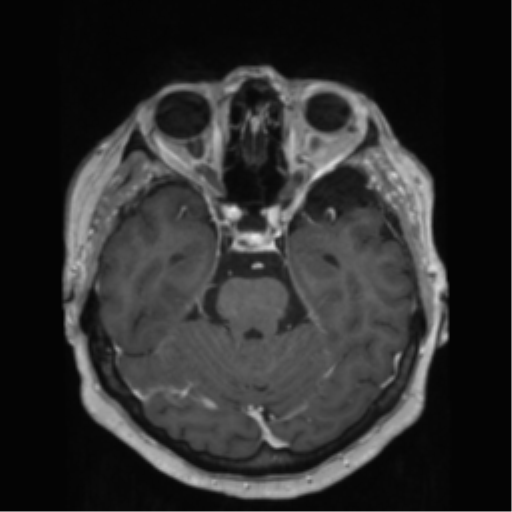 File:Anaplastic astrocytoma IDH wild-type (pseudoprogression) (Radiopaedia 42209-45278 Axial T1 C+ 60).png