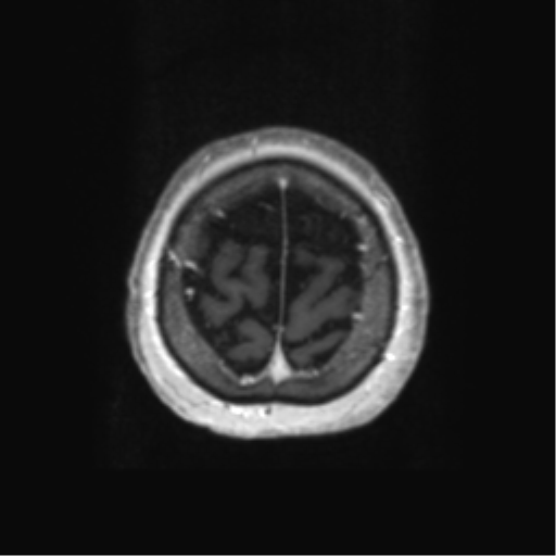 Anaplastic astrocytoma IDH wild-type (pseudoprogression) (Radiopaedia 42209-45279 Axial T1 C+ 127).png