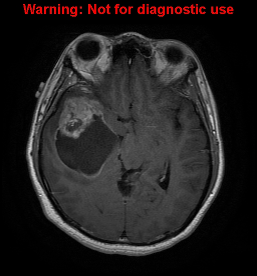 File:Anaplastic ganglioglioma (Radiopaedia 44921-48831 Axial T1 C+ 14).jpg