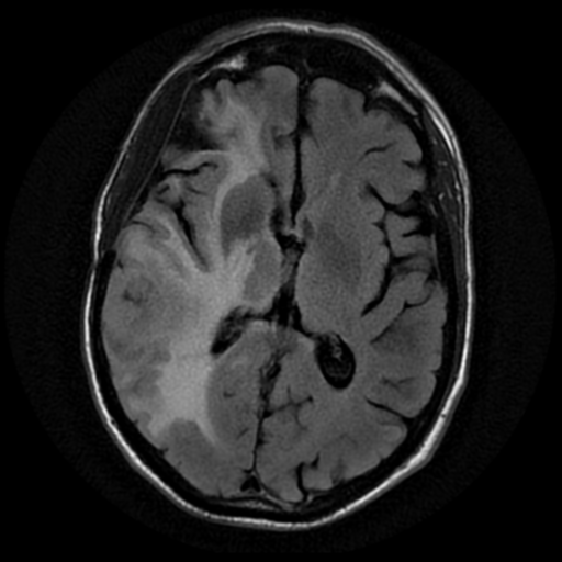 File:Anaplastic meningioma with recurrence (Radiopaedia 34452-35790 Axial T2 FLAIR 11).png