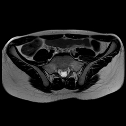 File:Androgen insensitivity syndrome (Radiopaedia 38585-40727 Axial T2 1).jpg
