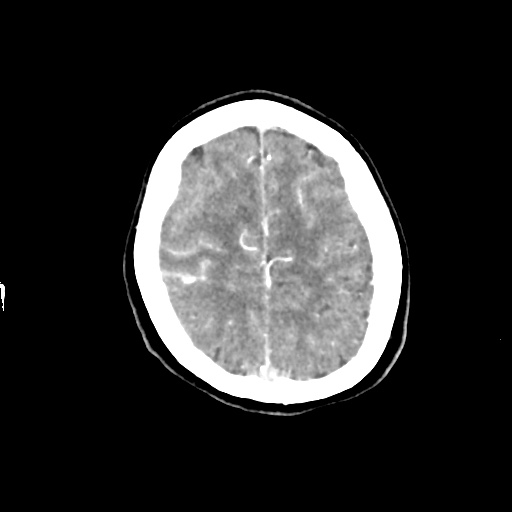 Aneursym related subarachnoid hemorrhage with hydrocephalus (Radiopaedia 45105-49084 D 44).jpg