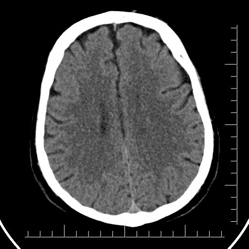 File:Aneurysm of posterior communicating artery (Radiopaedia 20188-20162 Axial non-contrast 32).jpg