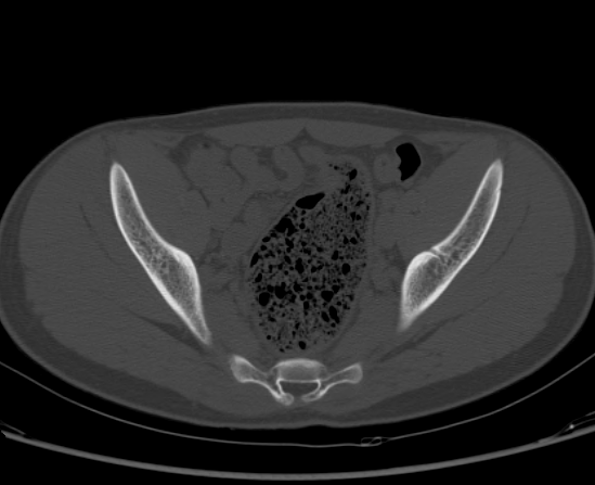 File:Aneurysmal bone cyst of ischium (Radiopaedia 25957-26094 Axial bone window 36).png