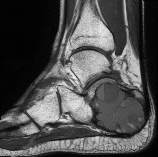 File:Aneurysmal bone cyst of the calcaneus (Radiopaedia 60669-68420 Sagittal T1 8).jpg