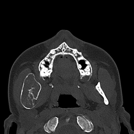Aneurysmal bone cyst of the mandible (Radiopaedia 43280-46601 Axial bone window 51).jpg