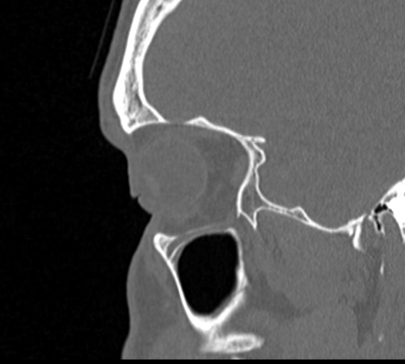 Angular epidermoid cyst (Radiopaedia 46908-51439 Sagittal bone window 13).png